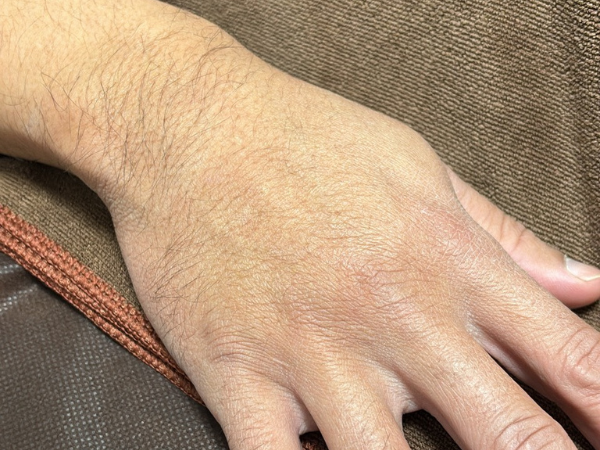 手の施術事例 施術前
